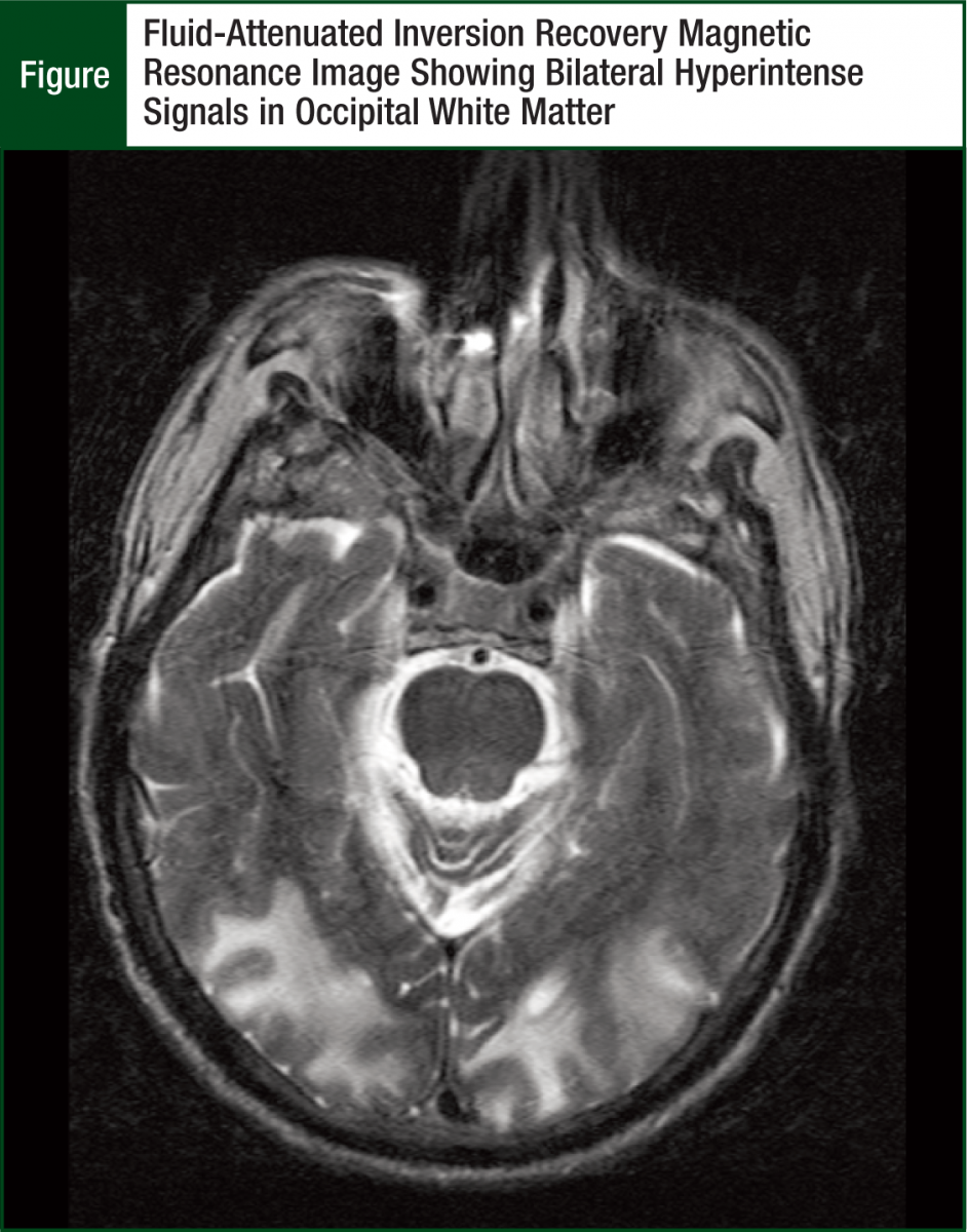 Fluid-Attenuated Inversion Recovery Magnetic
Resonance Image Showing Bilateral Hyperintense
Signals in Occipital White Matter